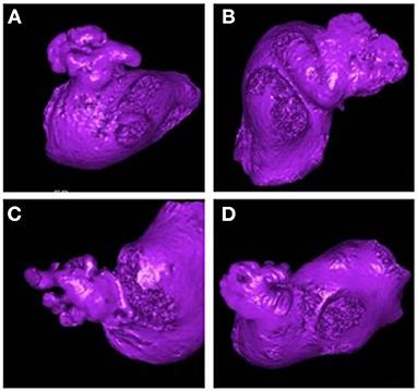 Stroke risk evaluation for patients with atrial fibrillation: Insights from left atrial appendage